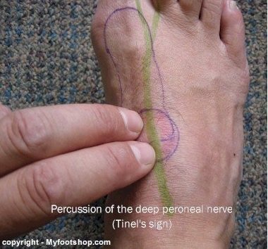 Testing for Tinel's sign of the deep peroneal nerve